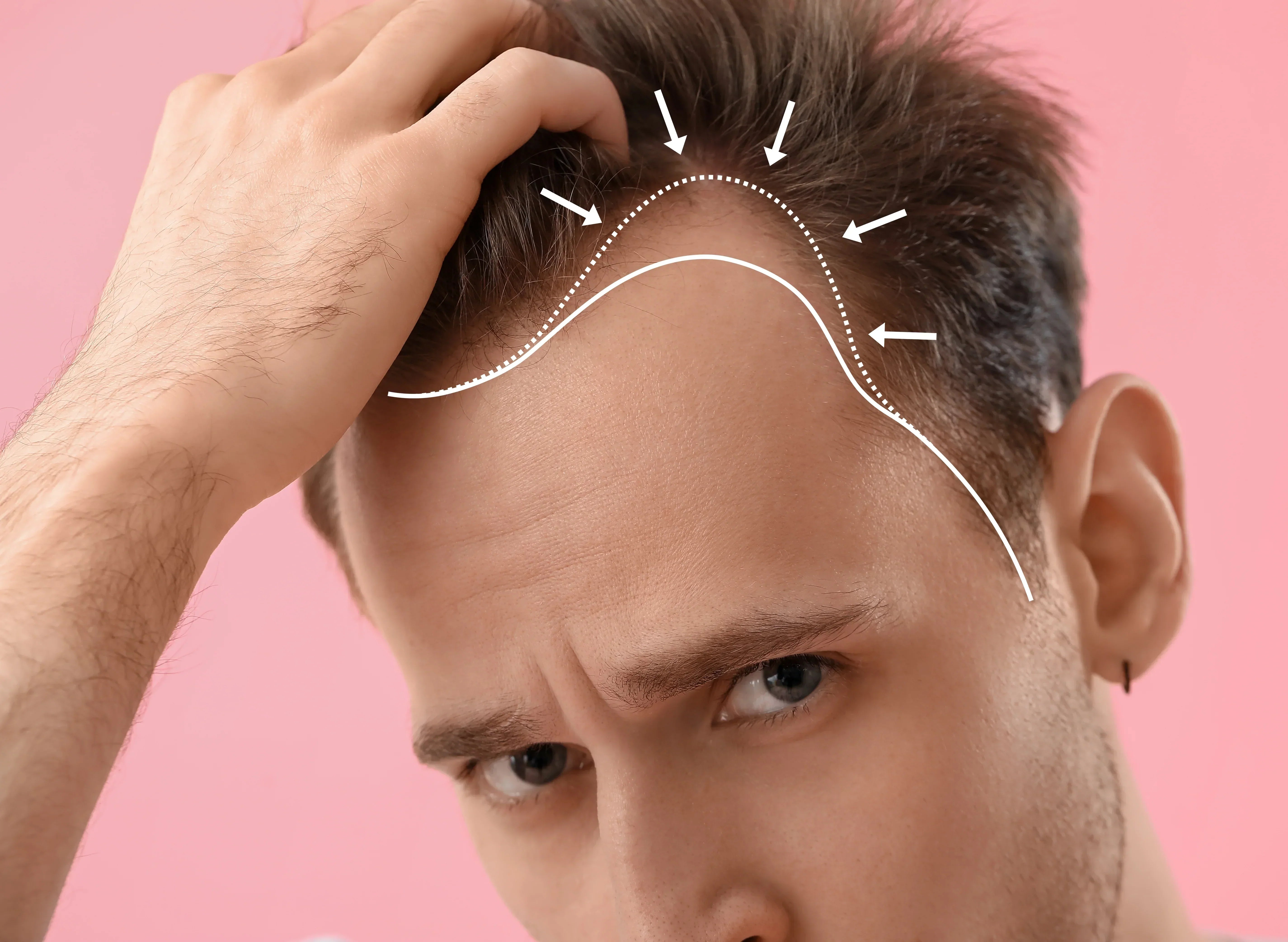 Diradamento dei Capelli: Cause, Segnali e Soluzioni